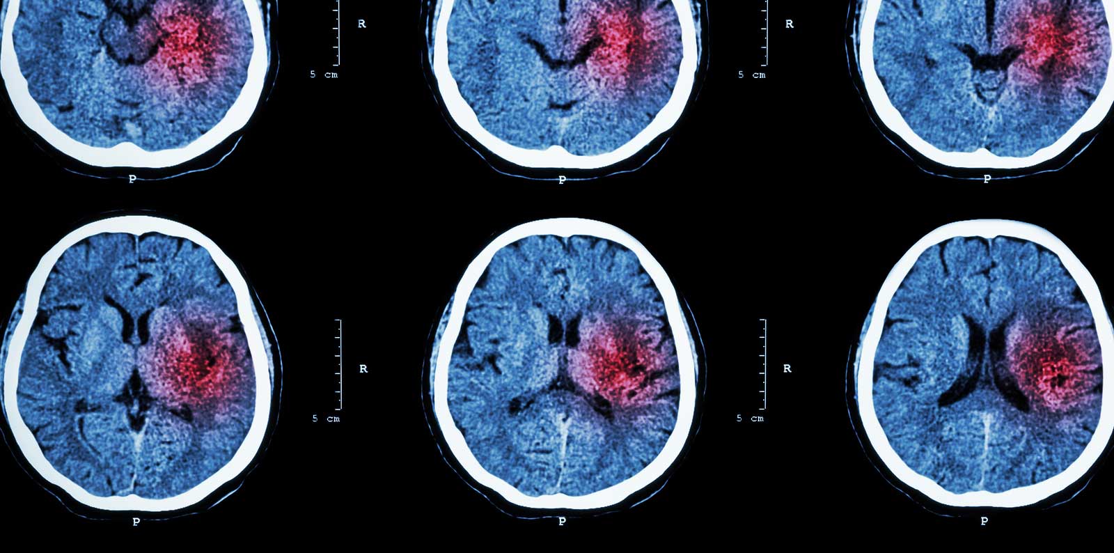 Subarachnoid Hemorrhage Symptoms & Treatment